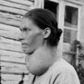 Avatar: Goiter